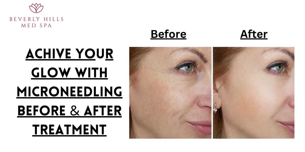 Achive your glow with Microneedling Before & After Treatment